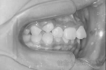 症例写真：出っ歯（上顎前突）