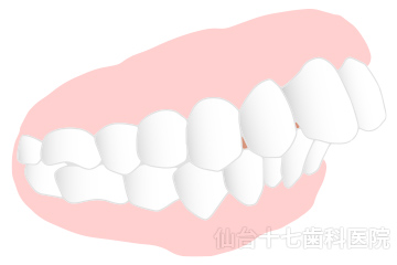 症例写真：出っ歯（上顎前突）